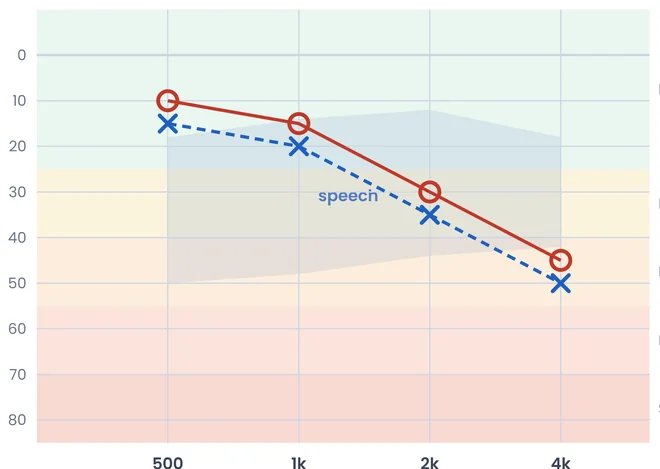 An audiogram showing the right ear as red circles and the left ear as blue crosses, sloping down towards the higher pitches.